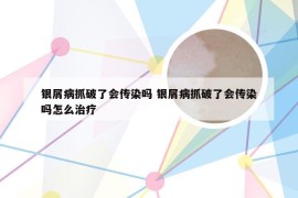 银屑病抓破了会传染吗 银屑病抓破了会传染吗怎么治疗