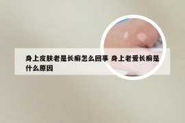 身上皮肤老是长癣怎么回事 身上老爱长癣是什么原因