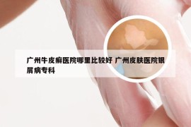 广州牛皮癣医院哪里比较好 广州皮肤医院银屑病专科