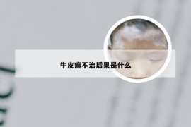 牛皮癣不治后果是什么