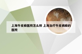 上海牛皮癣医院怎么样 上海治疗牛皮病癣的医院