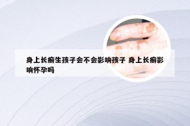 身上长癣生孩子会不会影响孩子 身上长癣影响怀孕吗