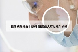 银屑病能喝鲜牛奶吗 银屑病人可以喝牛奶吗