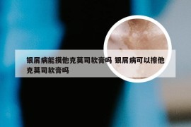 银屑病能摸他克莫司软膏吗 银屑病可以擦他克莫司软膏吗