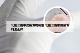 北医三院牛皮癣生物制剂 北医三院银屑病专科怎么样