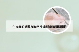 牛皮鲜的病因与治疗 牛皮鲜症状初期图片