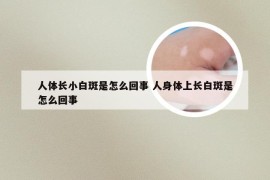 人体长小白斑是怎么回事 人身体上长白斑是怎么回事