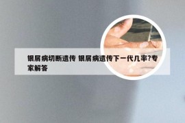 银屑病切断遗传 银屑病遗传下一代几率?专家解答