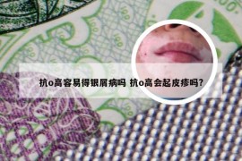 抗o高容易得银屑病吗 抗o高会起皮疹吗?