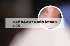 银屑病复发scc10 银屑病复发全身爆发小红点