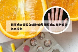 银屑病会导致白细胞低吗 银屑病白细胞偏高怎么控制