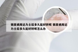 银屑病用达力士后多久能好转呢 银屑病用达力士后多久能好转呢怎么办