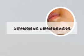 白斑会越变越大吗 白斑会越变越大吗女生