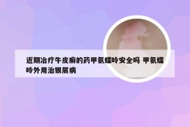 近期冶疗牛皮癣的药甲氨蝶呤安全吗 甲氨蝶呤外用治银屑病