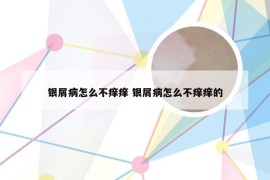 银屑病怎么不痒痒 银屑病怎么不痒痒的