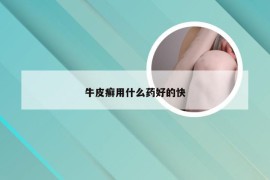 牛皮癣用什么药好的快