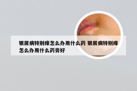 银屑病特别痒怎么办用什么药 银屑病特别痒怎么办用什么药膏好