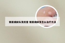 银屑病掉头发厉害 银屑病掉发怎么治疗方法