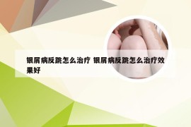 银屑病反跳怎么治疗 银屑病反跳怎么治疗效果好