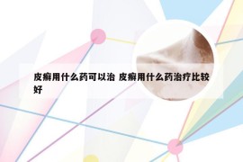 皮癣用什么药可以治 皮癣用什么药治疗比较好