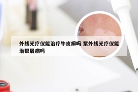 外线光疗仪能治疗牛皮癣吗 紫外线光疗仪能治银屑病吗