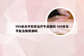 999皮炎平软膏治疗牛皮癣吗 999皮炎平能治银屑病吗