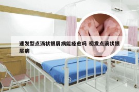 速发型点滴状银屑病能痊愈吗 初发点滴状银屑病