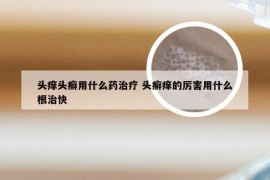 头痒头癣用什么药治疗 头癣痒的厉害用什么根治快