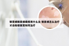 银霄病银屑病瘙痒用什么治 银屑病怎么治疗才会除根银霄如何治疗