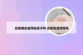 白斑病会遗传给孩子吗 白斑有遗传性吗