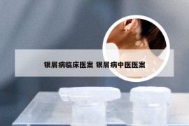 银屑病临床医案 银屑病中医医案