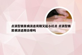 点滴型银屑病消退周期又起小红点 点滴型银屑病消退期会痒吗