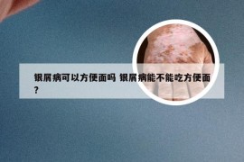 银屑病可以方便面吗 银屑病能不能吃方便面?