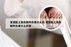 宝宝脸上有白斑咋办用什么药 宝宝脸上有白斑咋办用什么药膏