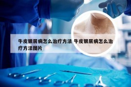 牛皮银屑病怎么治疗方法 牛皮银屑病怎么治疗方法图片