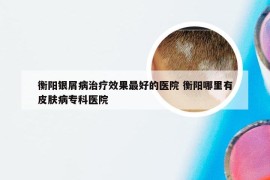 衡阳银屑病治疗效果最好的医院 衡阳哪里有皮肤病专科医院