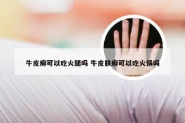 牛皮癣可以吃火腿吗 牛皮肤癣可以吃火锅吗