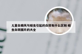 儿童白癜风与蛔虫引起的白斑有什么区别 蛔虫白斑图片的大全