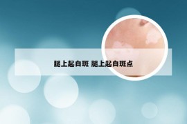 腿上起白斑 腿上起白斑点