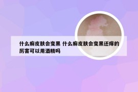 什么癣皮肤会变黑 什么癣皮肤会变黑还痒的厉害可以用酒精吗