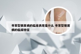 寻常型银屑病的临床表现是什么 寻常型银屑病的临床特征