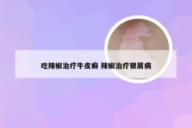 吃辣椒治疗牛皮癣 辣椒治疗银屑病