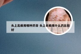 头上出癣用哪种药膏 头上长癣用什么药比较好