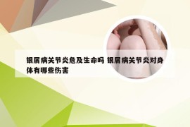 银屑病关节炎危及生命吗 银屑病关节炎对身体有哪些伤害