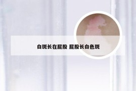 白斑长在屁股 屁股长白色斑