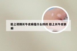 脸上初期长牛皮癣是什么样的 脸上长牛皮肤癣