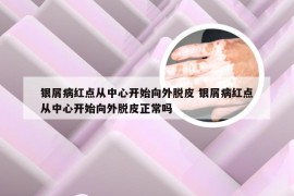 银屑病红点从中心开始向外脱皮 银屑病红点从中心开始向外脱皮正常吗