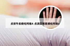 点状牛皮癣吃阿维A 点滴型银屑病吃阿维a