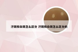 汗斑和白斑怎么区分 汗斑和白斑怎么区分的