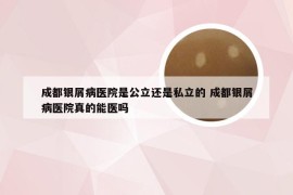 成都银屑病医院是公立还是私立的 成都银屑病医院真的能医吗